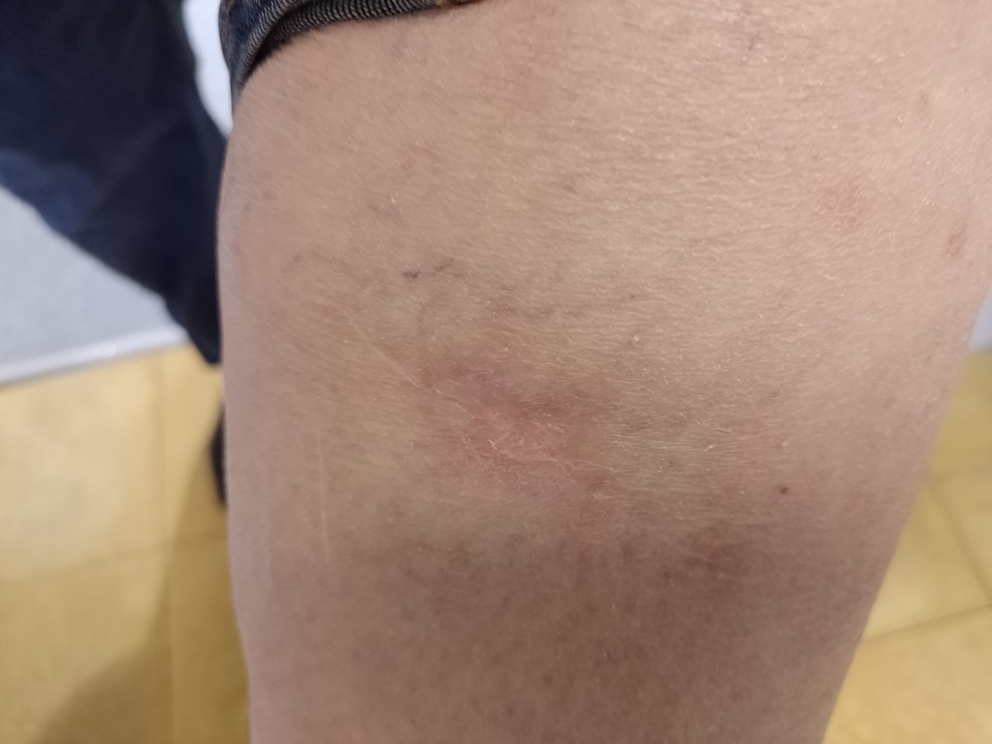 Cicatrice après traitement